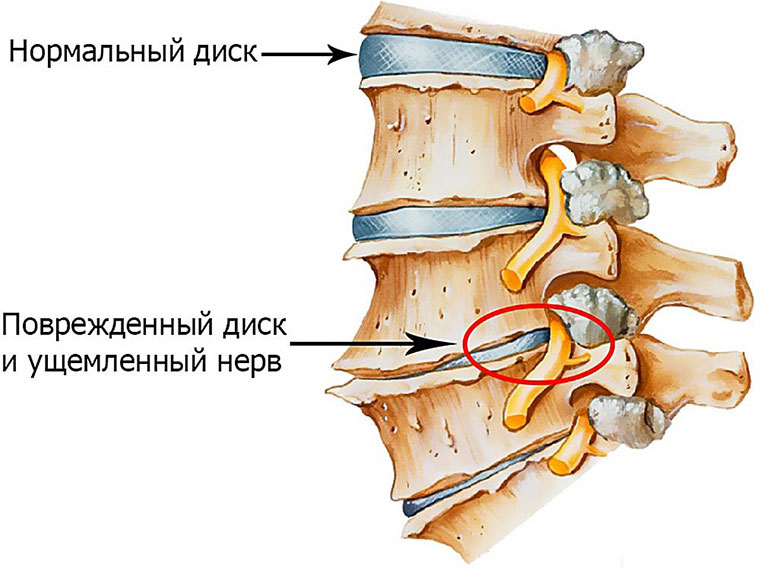 После гантелей болит спина