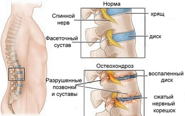 Здоровый и пораженный остеохондрозом позвонок Остеохондроз