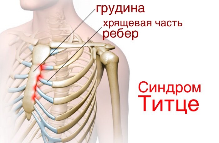 Синдром Титце