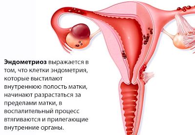 Перед и после месячных болит спина