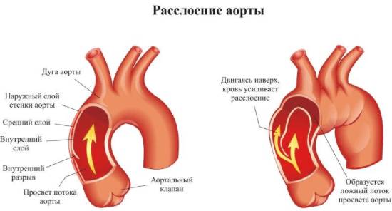 почему болит спина от сердца