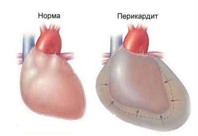 почему болит спина от сердца