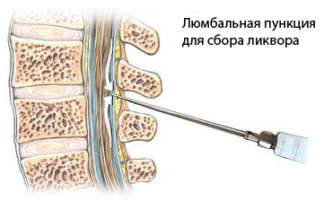 Люмбальная пункция Люмбальная пункция
