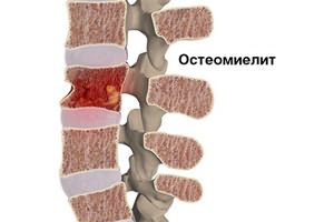 вечером поднимается температура и болит спина