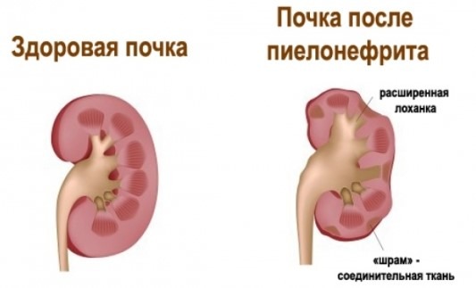 вечером поднимается температура и болит спина