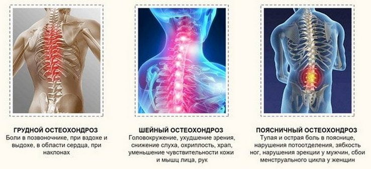 Виды остеохондроза Виды остеохондроза