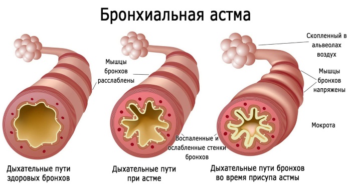 Лууле Виилма. Причины болезней, аффирмации. Заболевания позвоночника и суставов, пищеварительной, нервной системы, псориаз